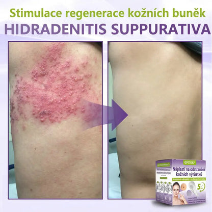 Vyrobeno a odesíláno z České republiky ✨ GFOUK® Rozpustné mikronáplasťové botanické náplasti na kožní výrůstky 🌴🌴
