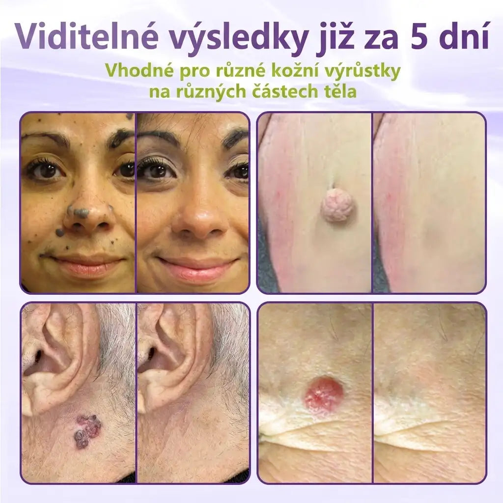 Vyrobeno a odesíláno z České republiky ✨ GFOUK® Rozpustné mikronáplasťové botanické náplasti na kožní výrůstky 🌴🌴