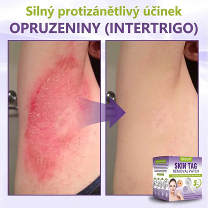 Vyrobeno a odesíláno z České republiky ✨ GFOUK® Rozpustné mikronáplasťové botanické náplasti na kožní výrůstky 🌴🌴
