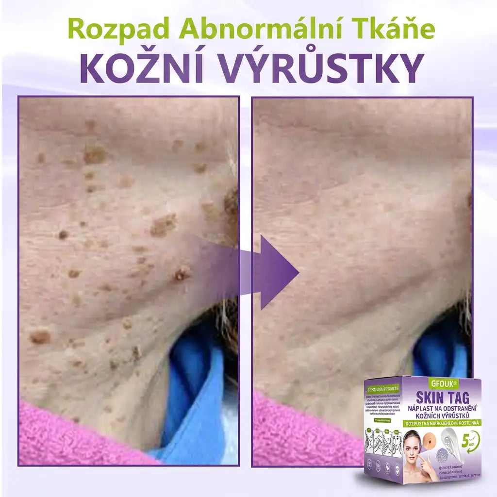 Vyrobeno a odesíláno z České republiky ✨ GFOUK® Rozpustné mikronáplasťové botanické náplasti na kožní výrůstky 🌴🌴