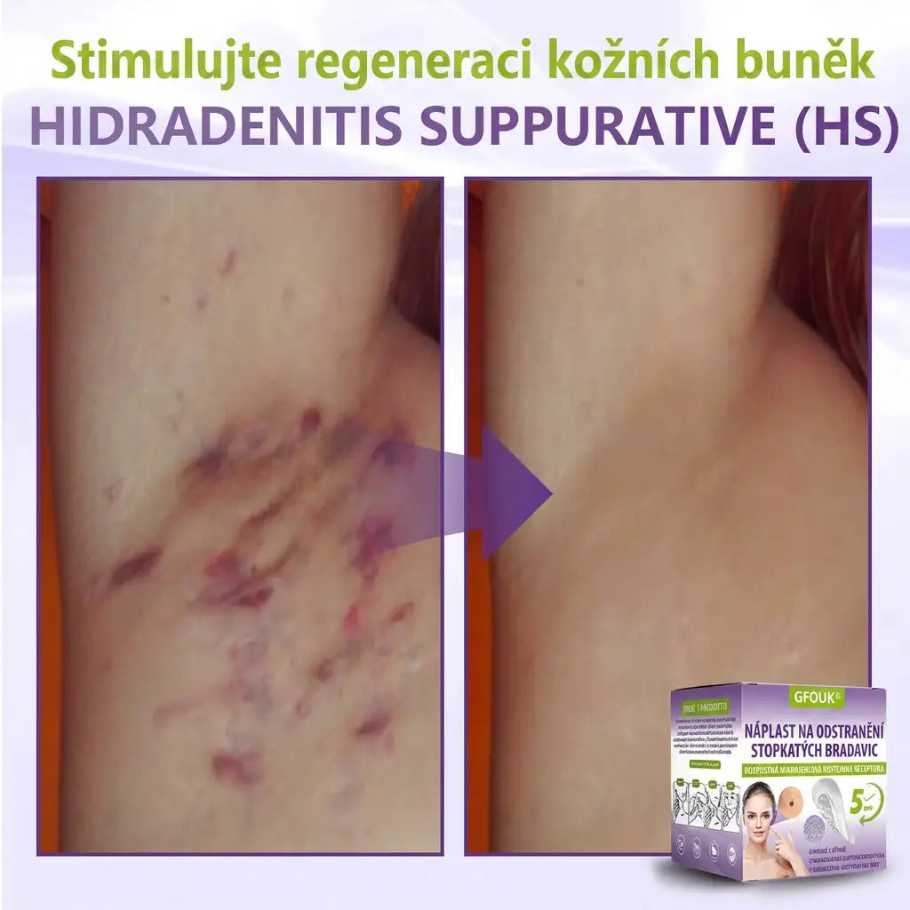 Vyrobeno a odesíláno z České republiky ✨ GFOUK® Rozpustné mikronáplasťové botanické náplasti na kožní výrůstky 🌴🌴